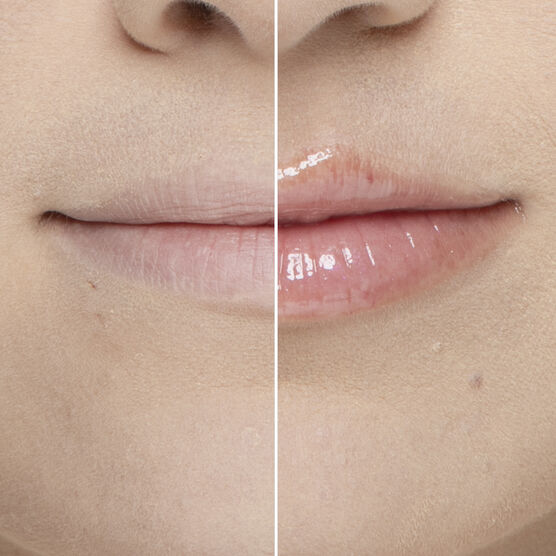 LIP INJECTION 1.5GR